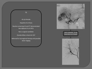 TS


                65 y/o female

             Hepatitis B cirrhosis

 Routine screening US and CT demonstrated
          two adjacent 4-cm HCCs

           Not a surgical candidate              TACE 1/26/2010: 75 mg
                                                 doxorubicin on LC beads
        Outside Milan criteria for OLT

Referred for locoregional therapy and possible
                 down-staging
 