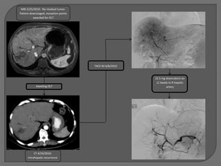 MRI 2/25/2010: No residual tumor.
Patient downstaged, exception points
          awarded for OLT




                                       TACE #2 6/8/2010



                                                          22.5 mg doxorubicin on
                                                           LC beads to R hepatic
            Awaiting OLT                                          artery




           CT 4/24/2010:
      Intrahepatic recurrence
 