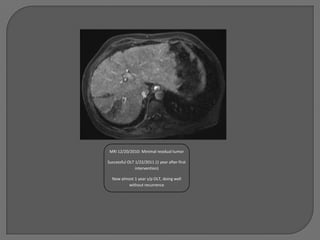 MRI 12/20/2010: Minimal residual tumor

Successful OLT 1/22/2011 (1 year after first
               intervention)

  Now almost 1 year s/p OLT, doing well
          without recurrence
 