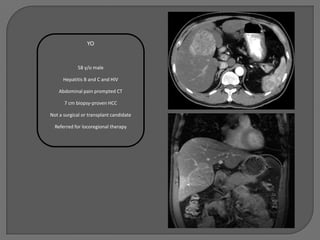YO


            58 y/o male

      Hepatitis B and C and HIV

    Abdominal pain prompted CT

      7 cm biopsy-proven HCC

Not a surgical or transplant candidate

  Referred for locoregional therapy
 
