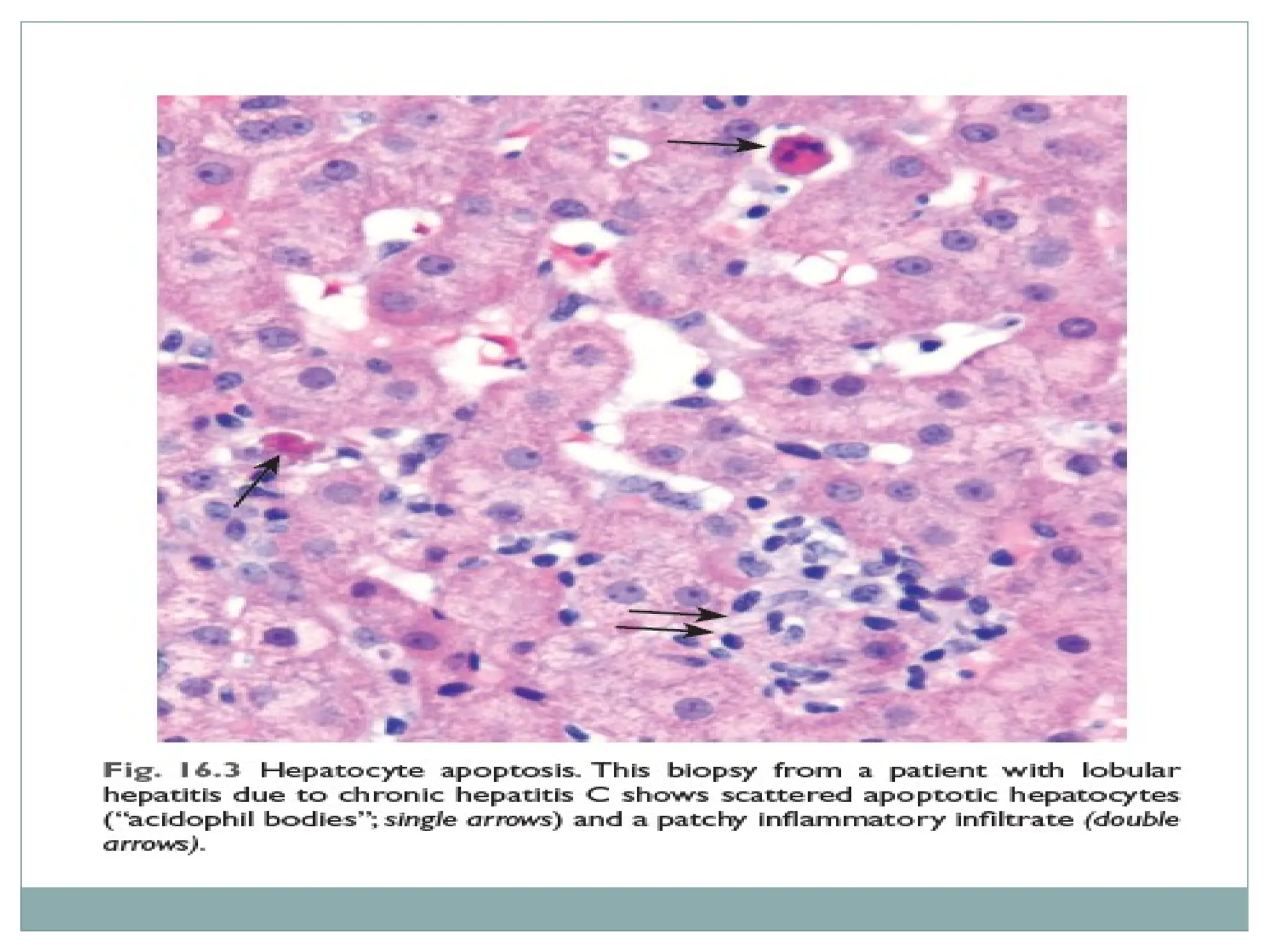 Hepatocyte Apoptosis Histology