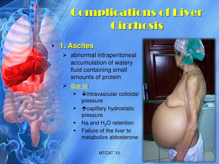 liver cirrhosis