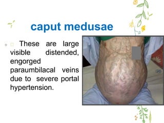 Caput Med Liver cirrhosis | PPTX