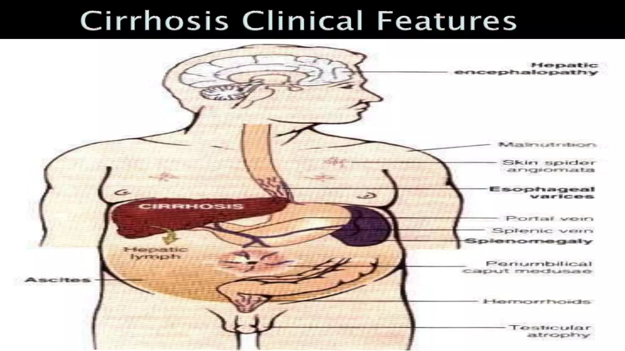 Liver cirrhosis Management | PPTX