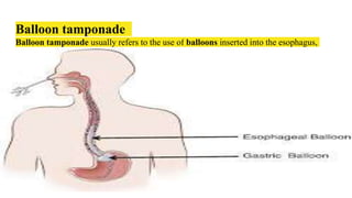 Balloon tamponade
Balloon tamponade usually refers to the use of balloons inserted into the esophagus,
stomach or uterus, and inflated to alleviate or stop refractory bleeding.
 