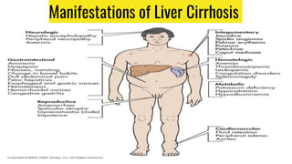 Manifestations of Liver Cirrhosis
 