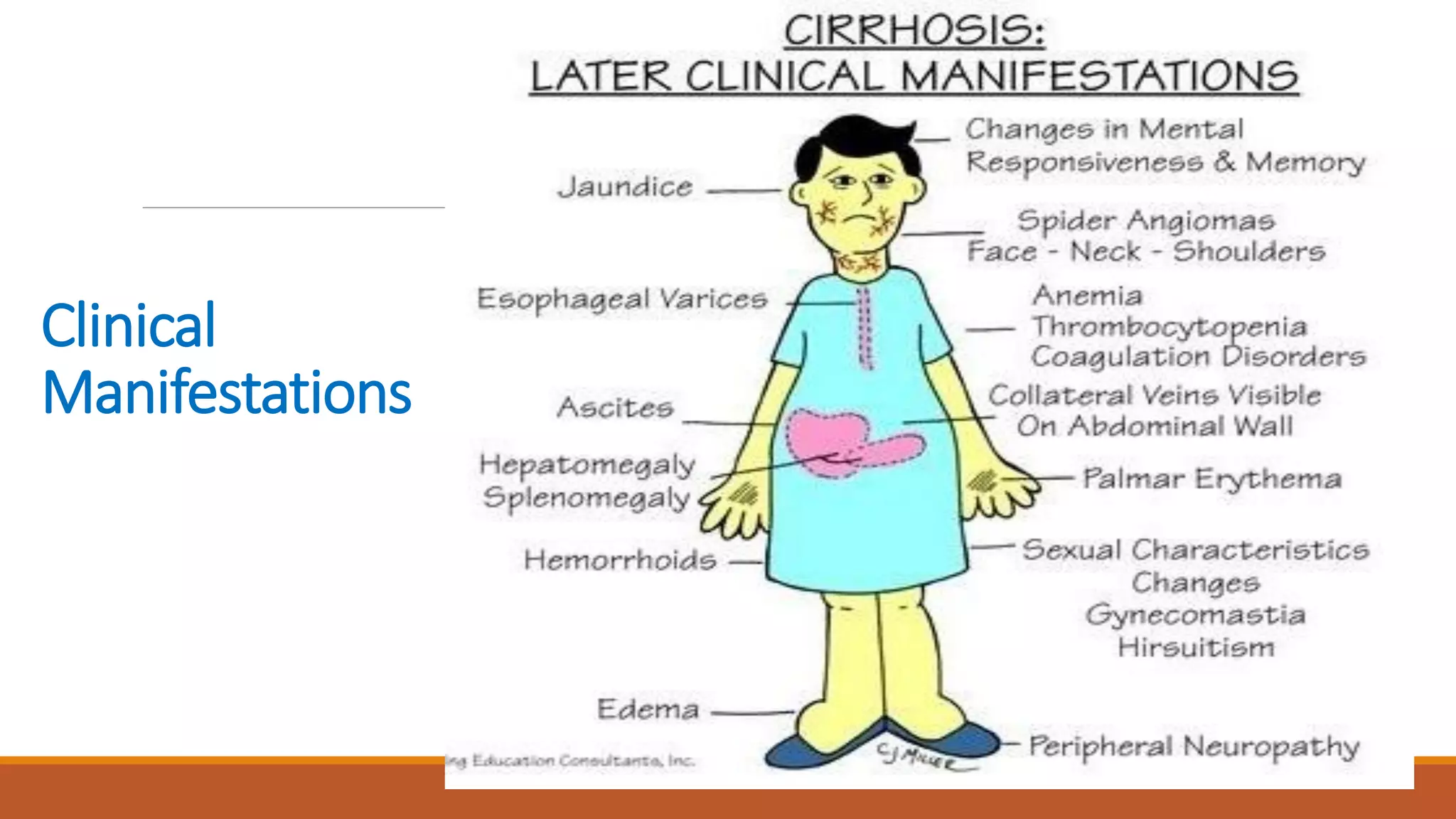 Liver cirrhosis for nursing | PDF