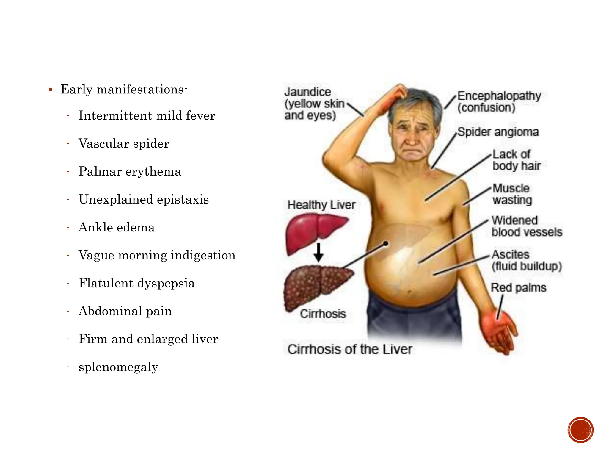 Liver Cirrhosis - etiology, types, pathophysiology, management ...