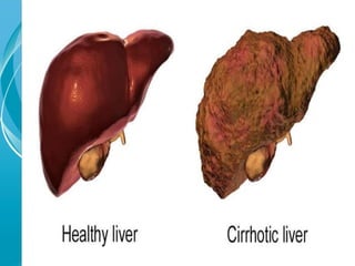 Ppt on Liver cirrhosis, management and its prevention.pptx