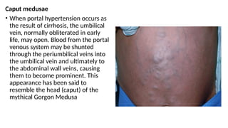 Caput Med Comprehensive Overview of Liver Cirrhosis: Causes, Symptoms, and ...