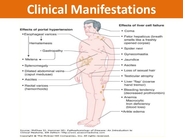 liver cirrhosis for students