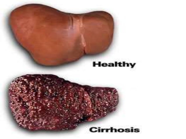 normal liver and cirrhosis liver