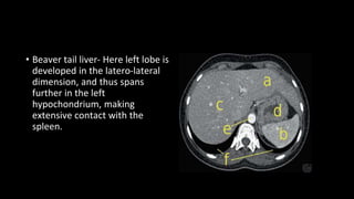 • Beaver tail liver- Here left lobe is
developed in the latero-lateral
dimension, and thus spans
further in the left
hypochondrium, making
extensive contact with the
spleen.
 