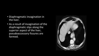 • Diaphragmatic invagination in
the liver.
• As a result of invagination of the
diaphragmatic slips along the
superior aspect of the liver,
pseudoaccessory fissures are
formed.
 