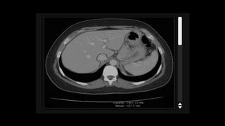 Liver ct anatomy(1).pptx