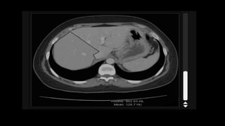 Liver ct anatomy(1).pptx