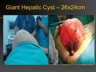 Giant Hepatic Cyst – 26x24cm 
 