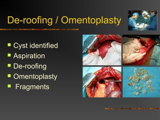 De-roofing / Omentoplasty 
 Cyst identified 
 Aspiration 
 De-roofing 
 Omentoplasty 
 Fragments 
 
