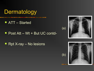 Dermatology 
 ATT – Started 
(a) 
 Post Att – Wt + But UC contd- 
 Rpt X-ray – No lesions 
(b) 
 