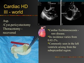 Cardiac HD 
III - world 
*Cardiac Ecchinococcosis - 
rare disease. 
*Its incidence varies from 
0.02-2%. 
*Commonly seen in the left 
ventricle arising from the 
subepicardial region. 
Asp. 
/Cyst.pericystectomy 
Thoracotomy - 
recovered 
 