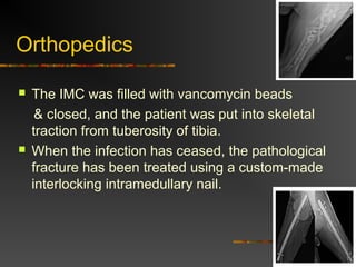 Orthopedics 
 The IMC was filled with vancomycin beads 
& closed, and the patient was put into skeletal 
traction from tuberosity of tibia. 
 When the infection has ceased, the pathological 
fracture has been treated using a custom-made 
interlocking intramedullary nail. 
 