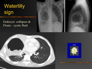 Waterlilly 
sign 
Endocyst collapses & 
Floats – cystic fluid 
 