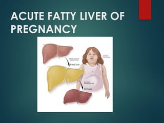 ACUTE FATTY LIVER OF
PREGNANCY
 