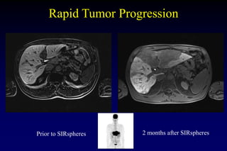 Rapid Tumor Progression
Prior to SIRspheres 2 months after SIRspheres
 