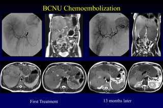 BCNU Chemoembolization
First Treatment 13 months later
 