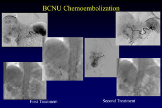 BCNU Chemoembolization
First Treatment Second Treatment
 