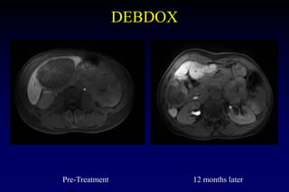 DEBDOX
Pre-Treatment 12 months later
 