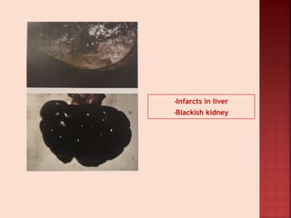 •Infarcts in liver
•Blackish kidney
 