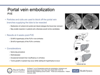 Liver diseases symposium interventional techniques and downstaging of ...