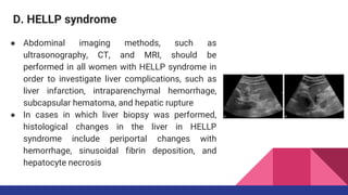 D. HELLP syndrome
● Abdominal imaging methods, such as
ultrasonography, CT, and MRI, should be
performed in all women with HELLP syndrome in
order to investigate liver complications, such as
liver infarction, intraparenchymal hemorrhage,
subcapsular hematoma, and hepatic rupture
● In cases in which liver biopsy was performed,
histological changes in the liver in HELLP
syndrome include periportal changes with
hemorrhage, sinusoidal fibrin deposition, and
hepatocyte necrosis
 
