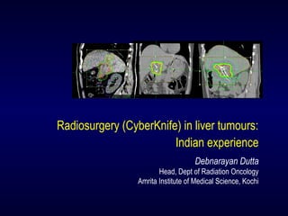 Radiosurgery (CyberKnife) in liver tumours:
Indian experience
Debnarayan Dutta
Head, Dept of Radiation Oncology
Amrita Institute of Medical Science, Kochi
 