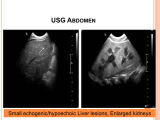 USG ABDOMEN
Small echogenic/hypoechoic Liver lesions, Enlarged kidneys
 