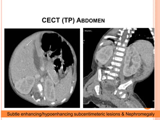 CECT (TP) ABDOMEN
Subtle enhancing/hypoenhancing subcentimeteric lesions & Nephromegaly
 