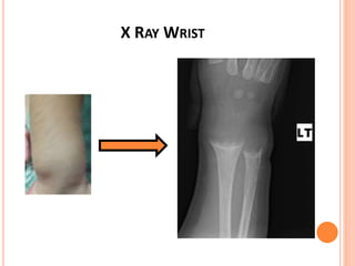 X RAY WRIST
 