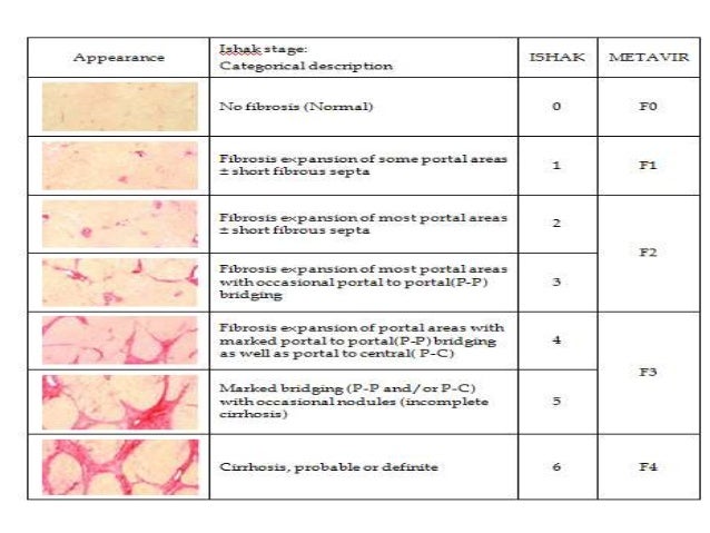 Fibrosis Score F4 | Liver Fibrosis – BAEUL