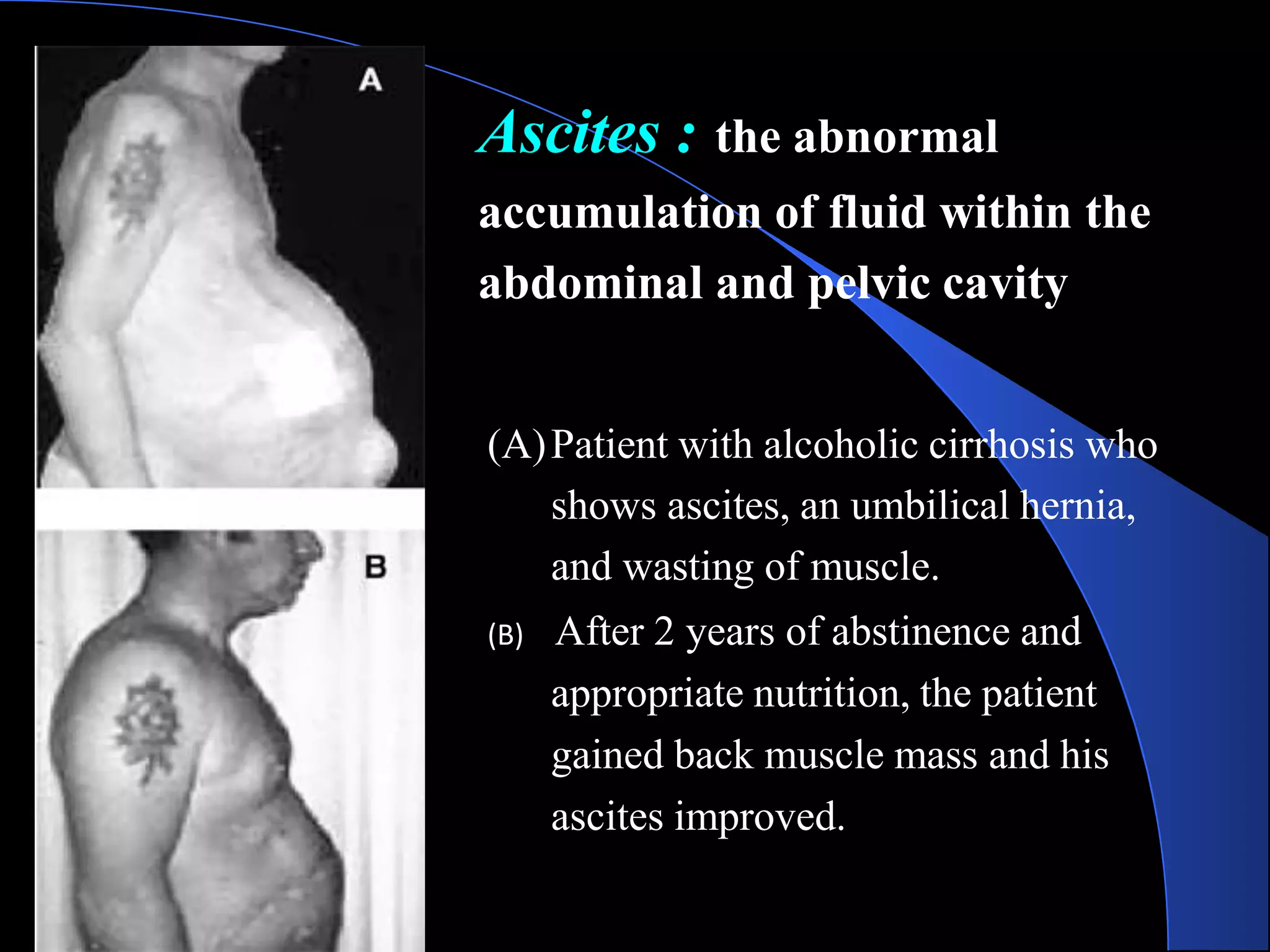Ascites : the abnormal
accumulation of fluid within the
abdominal and pelvic cavity
(A)Patient with alcoholic cirrhosis who
shows ascites, an umbilical hernia,
and wasting of muscle.
(B) After 2 years of abstinence and
appropriate nutrition, the patient
gained back muscle mass and his
ascites improved.
 