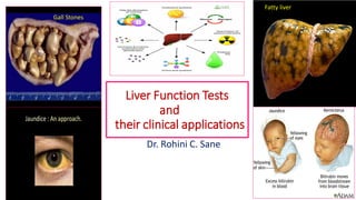 Liver Function Tests
and
their clinical applications
Dr. Rohini C. Sane
Gall Stones
Fatty liver
 