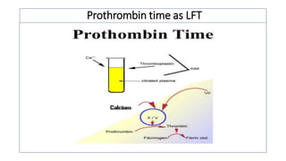 Prothrombin time as LFT
 