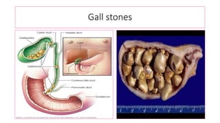 Gall stones
 