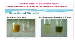 Gall stone analysis for presence of cholesterol
Salkowski and Liebermann Burchard’s Test: LFT associated with fat metabolism
 