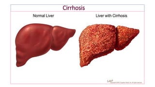 Cirrhosis
 