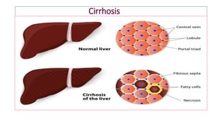 Cirrhosis
 