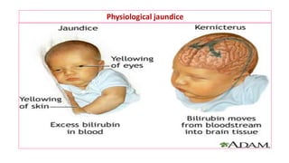 Physiological jaundice
 