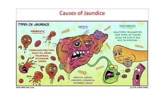 Causes of Jaundice
 