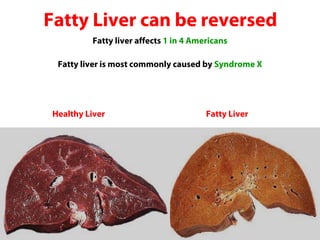 Fatty Liver can be reversed
          Fatty liver affects 1 in 4 Americans

  Fatty liver is most commonly caused by Syndrome X




 Healthy Liver                          Fatty Liver
 