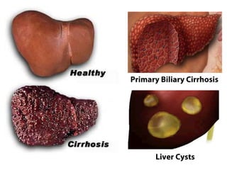 Primary Biliary Cirrhosis




       Liver Cysts
 